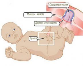 Omphalocele Umbilical hernia of the fetus 10 weeks